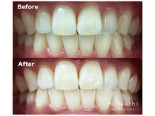 ハイティース 高田馬場店(Hi Teeth!)/美容セルフホワイトニング