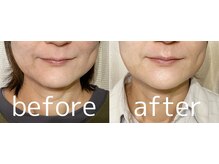 ララスマイル 鶴崎森町店/たるみ 頭痛 不眠 巻き肩 整体