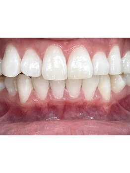 美白ケアをしたい