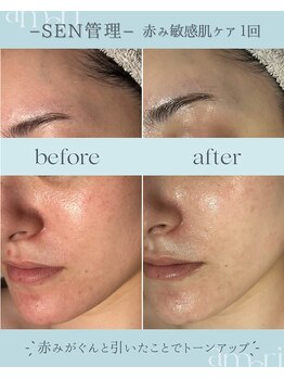 スキンラボアメリ(skin lab. ameri)/お悩み…赤みニキビゆらぎ肌