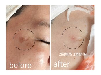 キレイラボ(Ki-Re-i LABO)/シミスポットケア