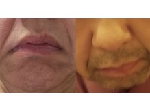 サロン シェリー 大島(Salon Cherie)/髭脱毛