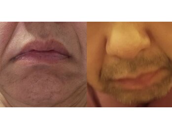 サロン シェリー 大島(Salon Cherie)/髭脱毛