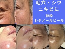 フェリス(FELIZ)の雰囲気（シワにアプローチ！ハリツヤ求めるなら純粋レチノールピール）