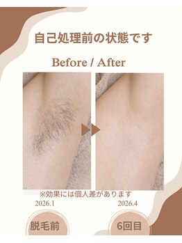リーナ 二俣川(Ri-Na)/脱毛は後悔しない