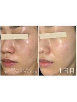 モイ(moi.)/◆Wピーリング◆