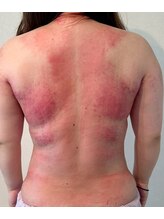 ビレイ(Birei)/全身カッサ