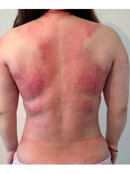 ビレイ(Birei)/全身カッサ