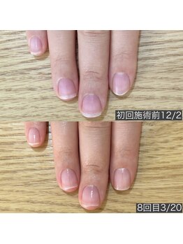 自爪育成ネイルケア