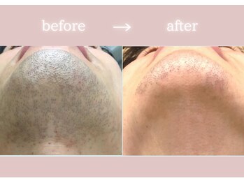 アネーロ(anhelo)/メンズヒゲ脱毛！