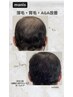 《本気の育毛促進》結果重視！幹細胞100%導入！頭皮改善！¥33000→¥15000