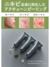 【繰り返すニキビ肌改善&皮脂改善】アクチューンピーリング50分¥9,800