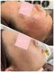ビエル(Bielle)の写真/《皮膚科提携》サロン×ホームケアで最短肌改善4万人実績◎何をやっても改善しなかった赤みニキビケアに◎