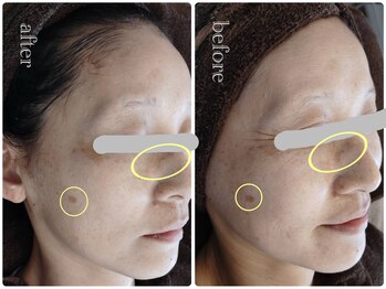 ポノ(Pono)/美白、シミ、しわに