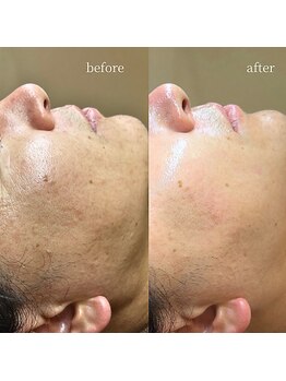 アーネスト 大阪心斎橋店(EARNEST)/PHAピール【 法令線の溝深さ 】