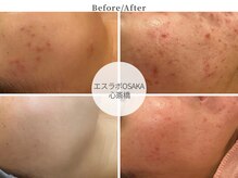 本気の肌質改善