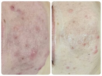 リセラージュ(Recellage)/【大人ニキビ改善】揺らぎ肌に◎