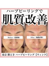 ウィンク 勝どき(wink)/ハーブピーリング