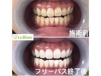 ルブラン 奈良店(Le Blanc)/お口元に自信が持てます。