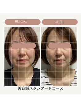 サロン ド ハリッシュ(Salon de HARISH)/頬の引き締まり