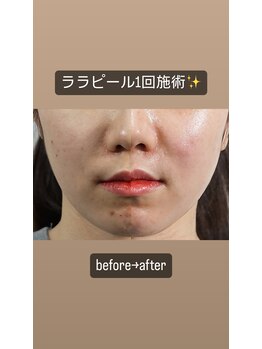 サロン ナビ(salon nabi.)/ララピールbefore→after♪