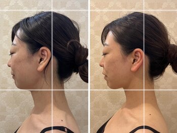 リアン(Lien)の写真/《花嫁様★支持率NO.1》横顔ライン＆小顔＆美肌！骨格特化の小顔矯正/毛穴洗浄/ホウレイ線ケアなど！ 