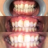 ティースクリーン(Teeth Clean)
