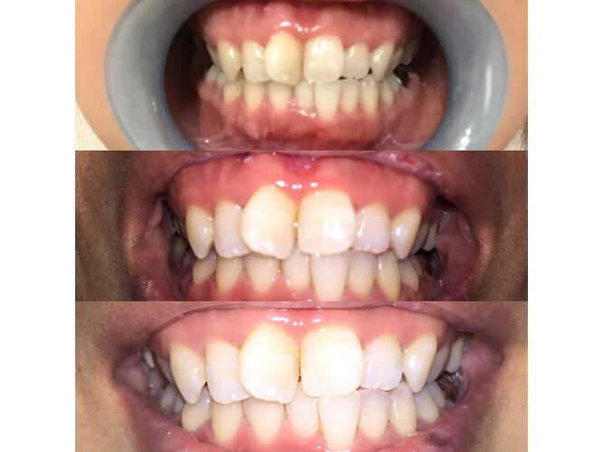 ティースクリーン(Teeth Clean)｜ホットペッパービューティー 【本日限定価格】tee ホワイトニング