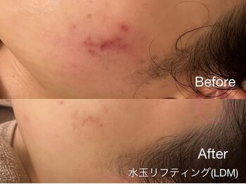 サロンヴェアリー 広尾(salon vary)/ニキビの赤み、鎮静#lbm