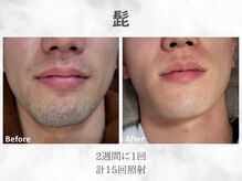 ベル(Belle)/メンズヒゲ脱毛