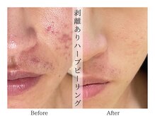 リララ(lelala)/ビフォーアフター☆