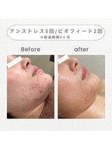 ノドカ 新市街店(NODOKA)/赤みのあるニキビをしっかり鎮静