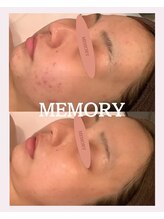 メモリー(MEMORY)/お肌悩み解消☆