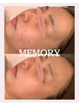 メモリー(MEMORY)/お肌悩み解消☆