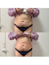 ミージュ(Miiju.)/本気痩せなら8カップ