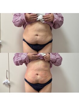 ミージュ(Miiju.)/本気痩せなら8カップ