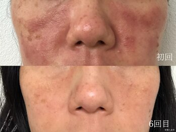 ウォーム(warm)/肌質改善/岡山/フェイシャル