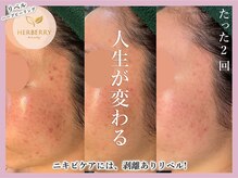 ハーバリー ハーブピーリング 大阪梅田店(HERBERRYハーブピーリング)/梅田ハーブピーリングHERBERRY