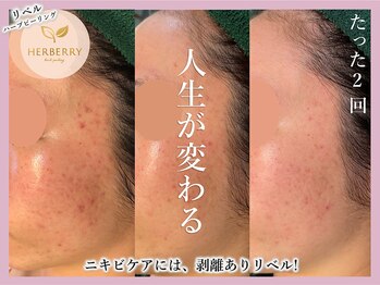 ハーバリー ハーブピーリング 大阪梅田店(HERBERRYハーブピーリング)/梅田ハーブピーリングHERBERRY