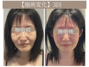 ドクターボディ 恵比寿店(Dr.Body)/【目の下のたるみ/歪み 50代】