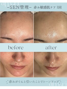 スキンラボアメリ(skin lab. ameri)/お悩み…赤みニキビ敏感肌