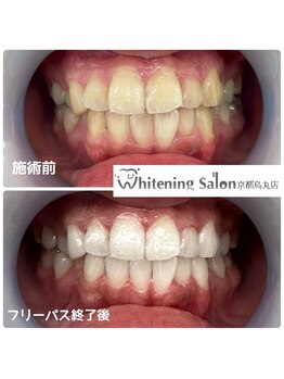 ホワイトニングサロン 京都烏丸店/ホワイトニング施術例