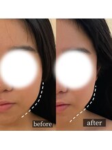 メルシートータルビューティー(MERCI)/小顔矯正