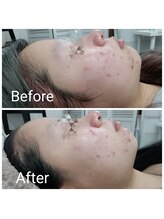 レン(Ren)/ハーブピーリング（１回）