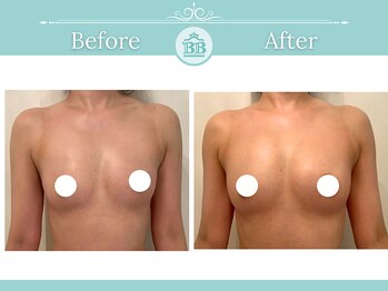 美人バスト 浦和店/【バストアップ★育乳】症例