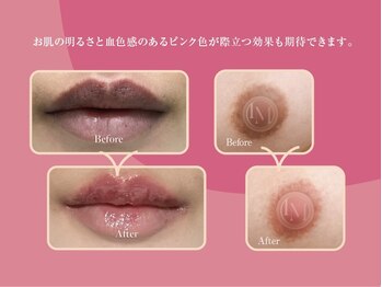 ホワイトニング ハナ 南本町店(WHITENING HANA)/デリケートゾーンのケアも