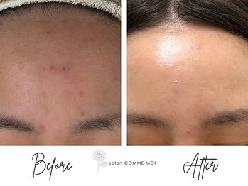 サロン コムモア(salon COMME MOI)の写真/毛穴・ニキビ・乾燥悩みとお別れ!オールハンドフェイシャルで健やかなお肌へ導きます★
