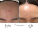 サロン コムモア(salon COMME MOI)の写真/毛穴・ニキビ・乾燥悩みとお別れ!オールハンドフェイシャルで健やかなお肌へ導きます★