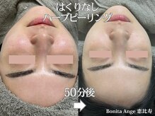 ボニータアンジュ 恵比寿(Bonita Ange)/渋谷恵比寿ハーブピーリング症例