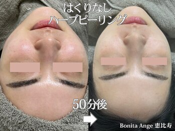 ボニータアンジュ 恵比寿(Bonita Ange)/渋谷恵比寿ハーブピーリング症例